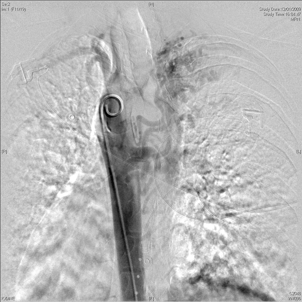 aortogram