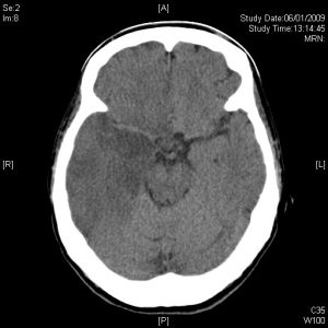 brain 2