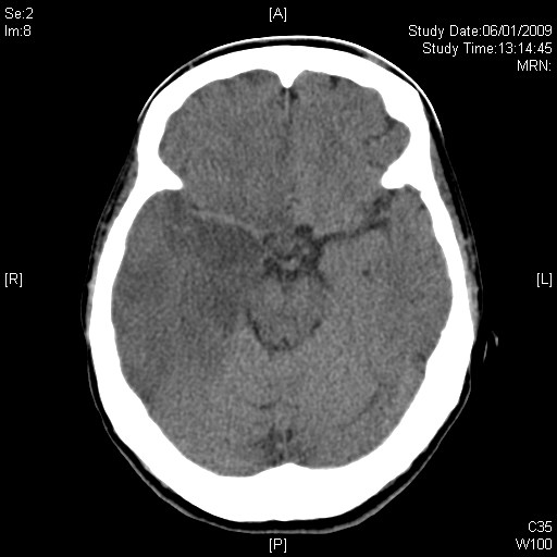 brain 2