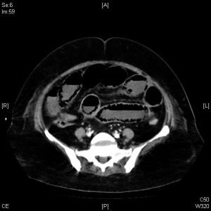 ct 1