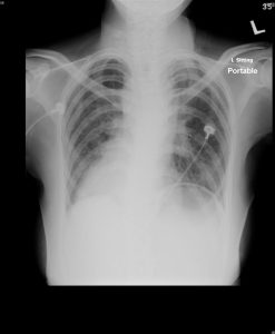cxr hemoptysis