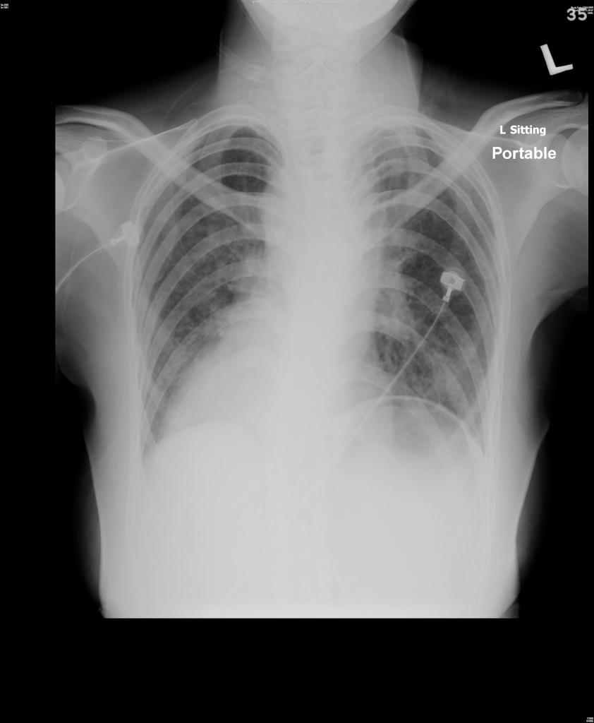 cxr hemoptysis