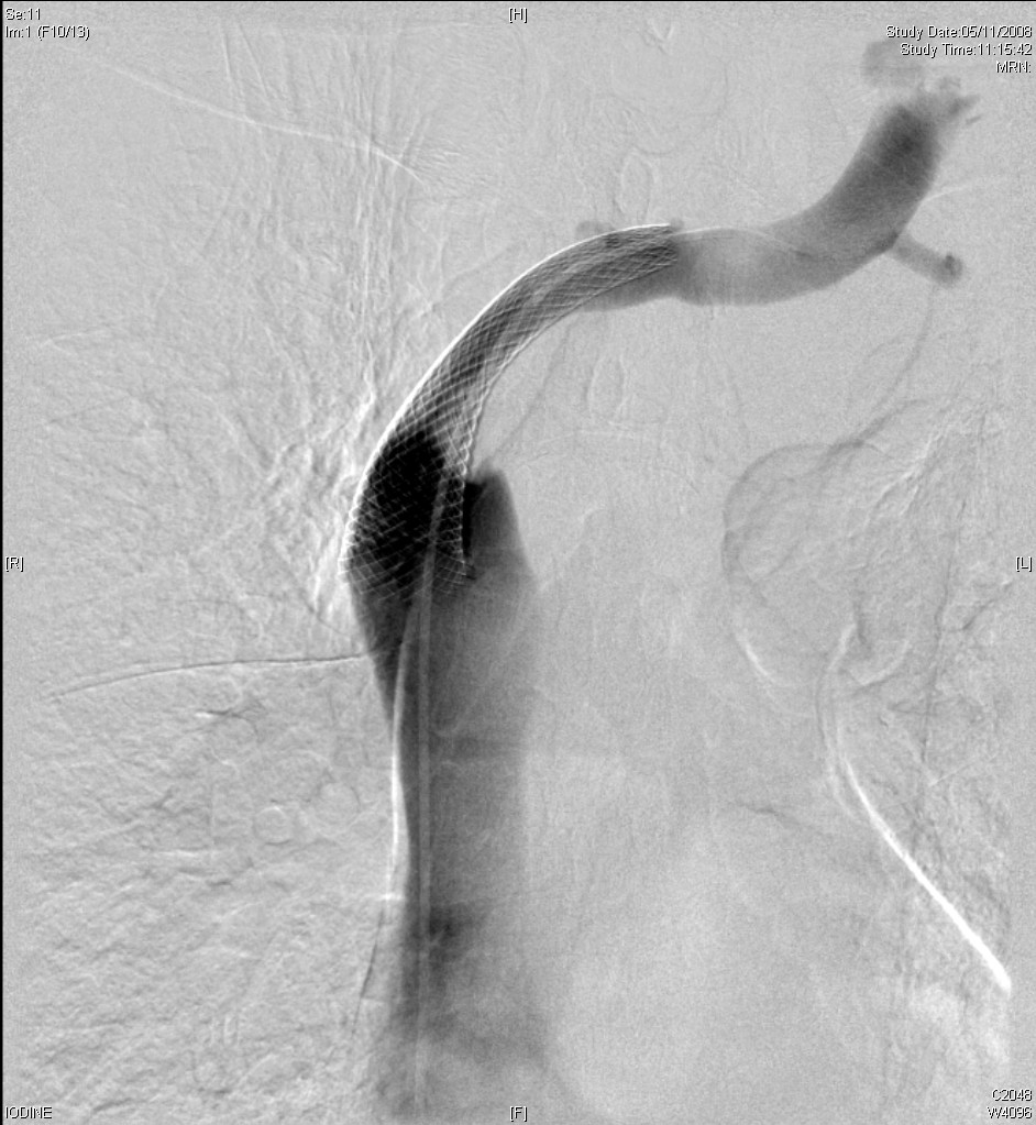 2008.11.05 l bcv post stent