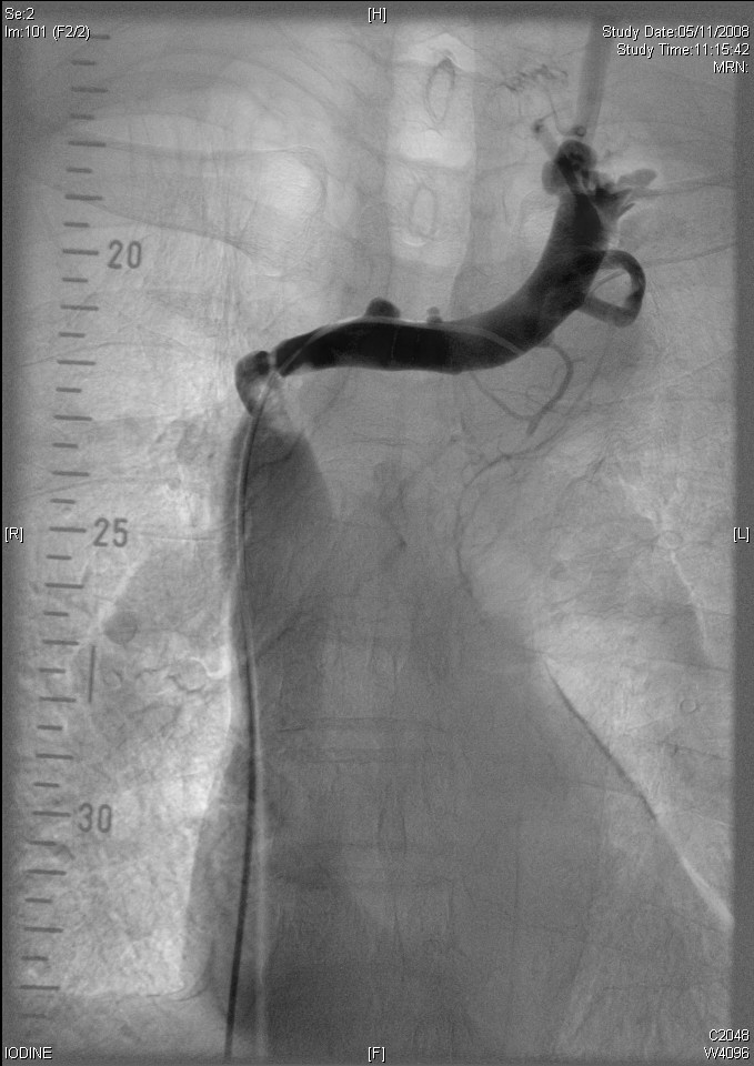2008.11.05 l bcv pre stent