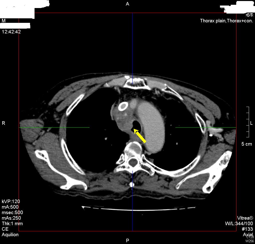 2008.12.02 r bcv svc thrombosis