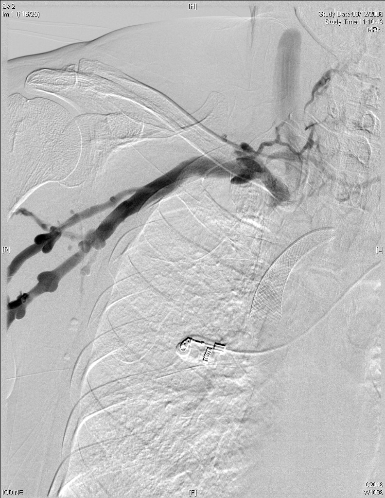 2008.12.03 r upper limb venogram