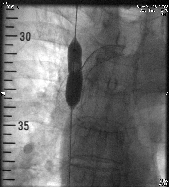 2008.12.05 venogram balloon
