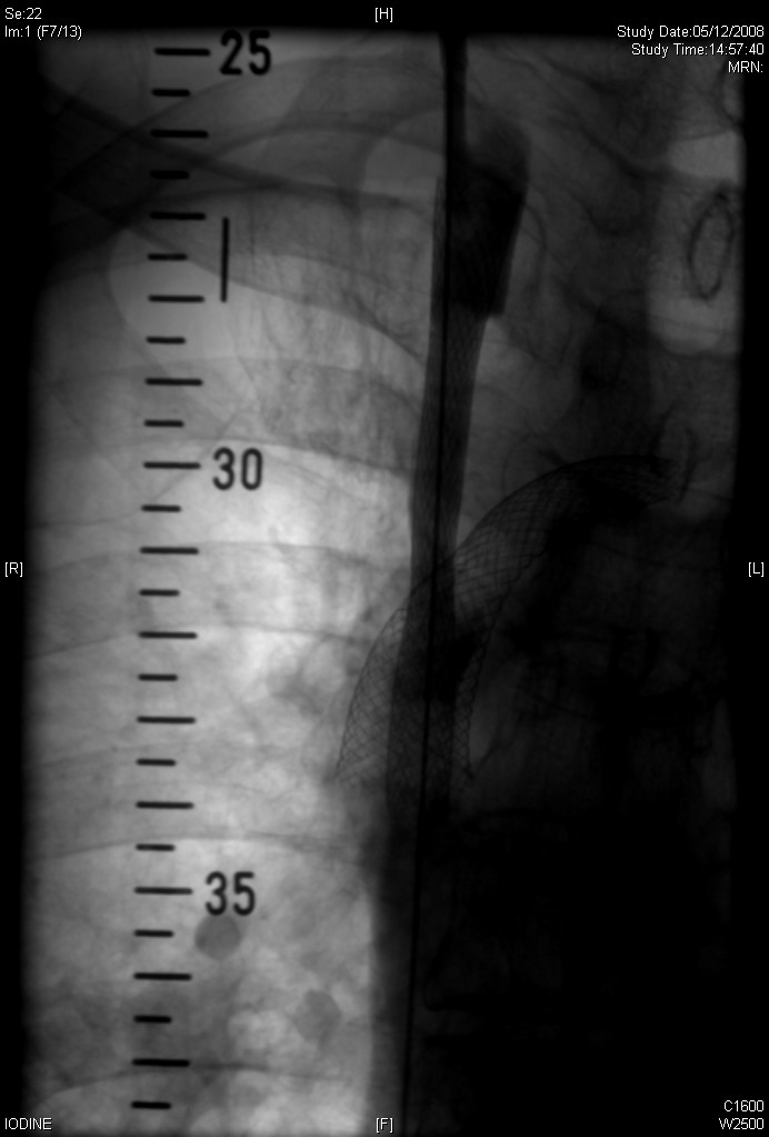 2008.12.05 venogram stent