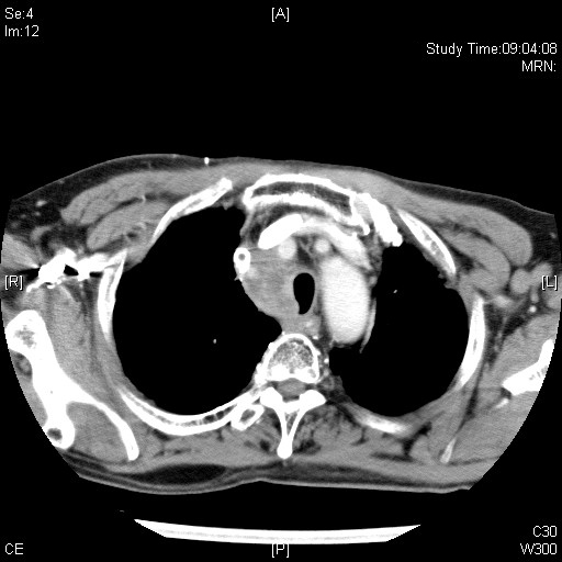 2009.02.09 ct thorax mod