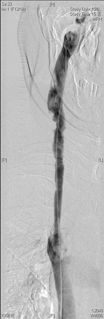 2009.02.10 rij post thrombolysis