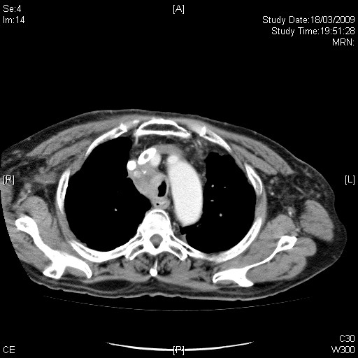 2009.03.18 ct thorax