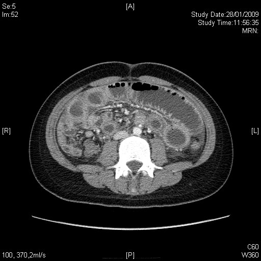 28_1 ct abd contrast ct dilated bowel
