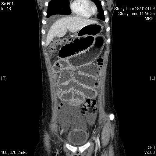 28_1 ct abd coronal dilated bowel