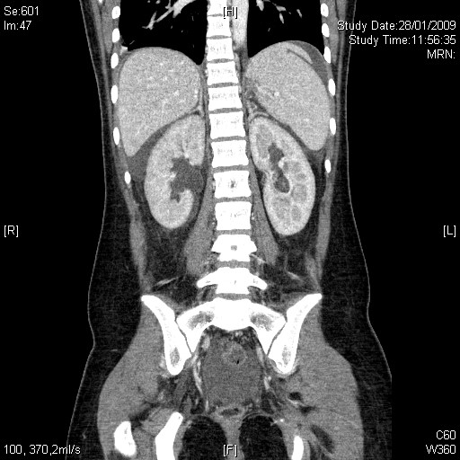 28_1 ct abd coronal spleen kidney