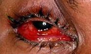 eye