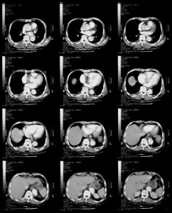 type a dissection