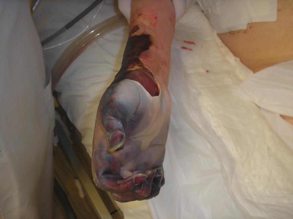 Figure 3: Wet gangrene in right hand. Mid- palm view. Fingers with dry gangrene.