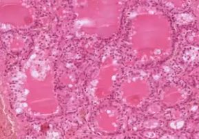 Thyroid histology in Graves Disease