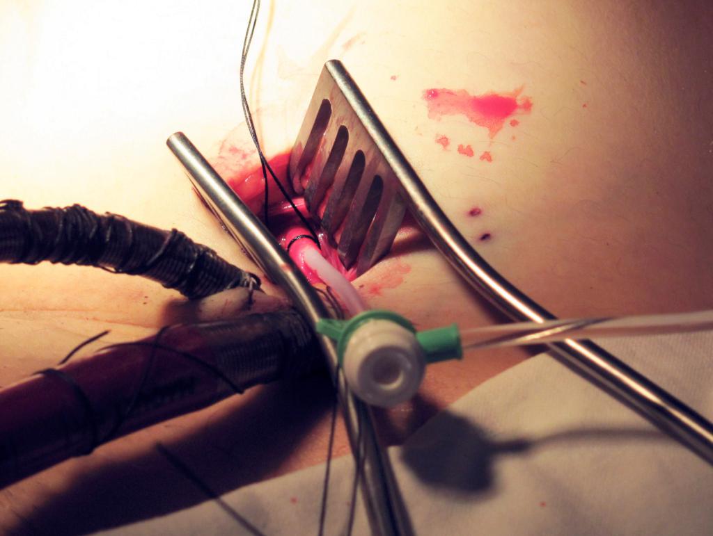 Direct cutdown to the femoral artery being performed with insertion of the small cannula for distal perfusion