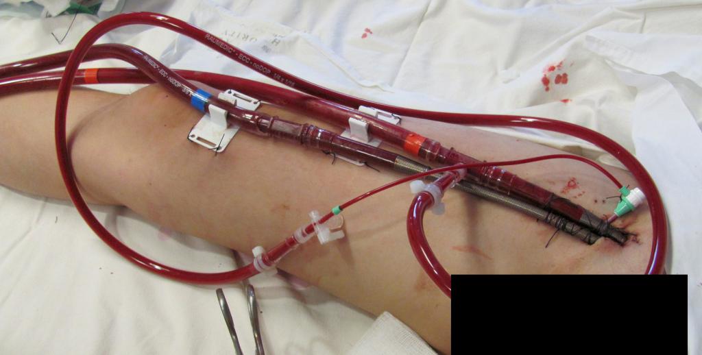 Femoral vein and artery cannulation with the distal perfusion cannula in-situ (right lower limb)