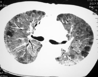 Pneumocystis Carinii Pneumonia
