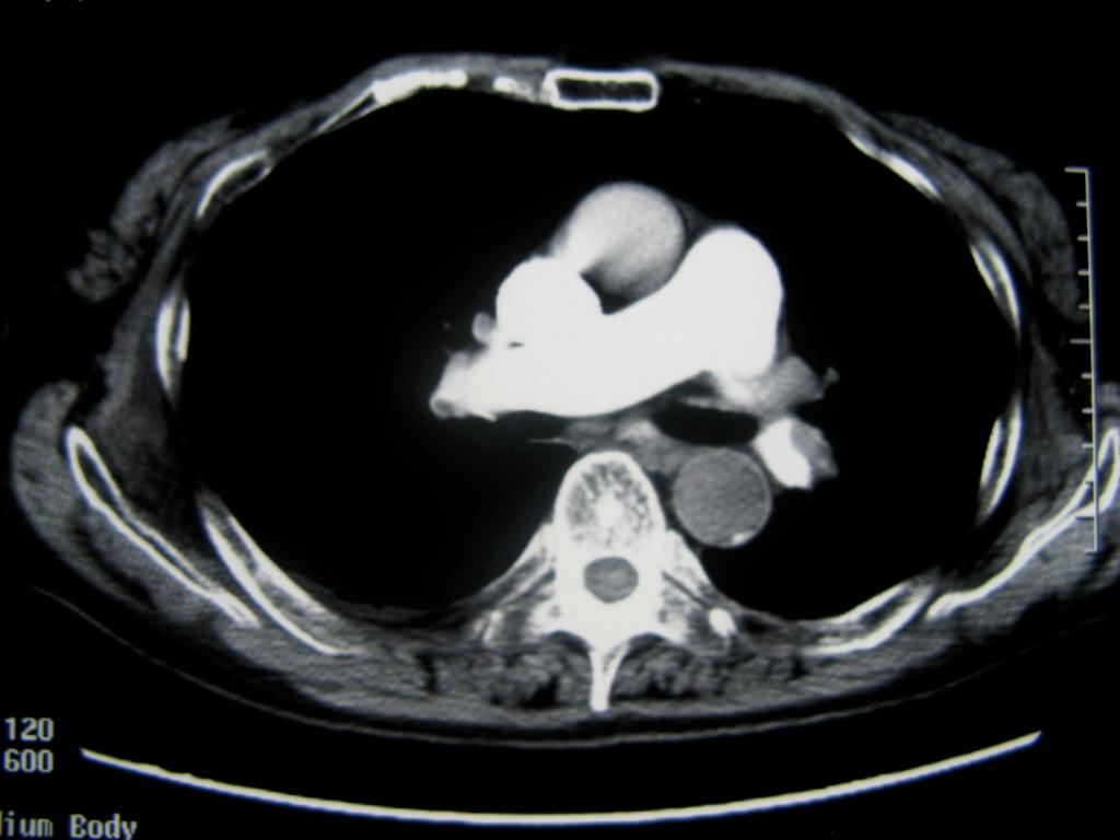 Figure. Pulmonary Embolism