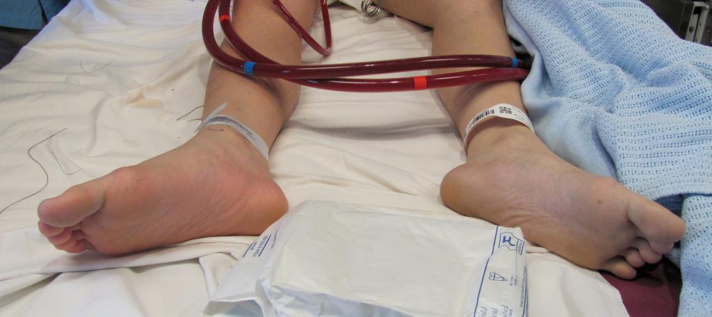 Post distal perfusion catheter insertion, Right lower limb shows some hyperremia, both due to higher blood flow through the catheter and reactive hyperremia after reperfusion.
