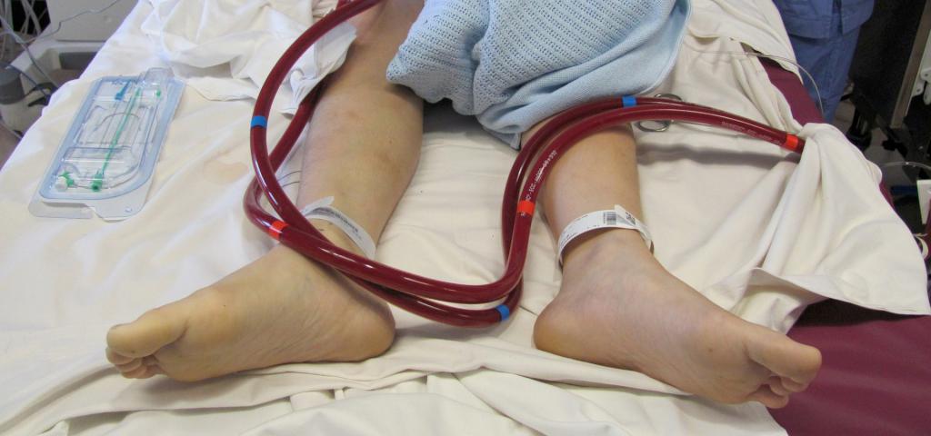 Figure. Condition of the lower limbs soon after R femoral artery and R femoral vein cannulation. Arterial circulation to both lower limbs is poor because of poor cardiac function, and right side is particularly poor with more significant coldness and impairment of capillary refill.