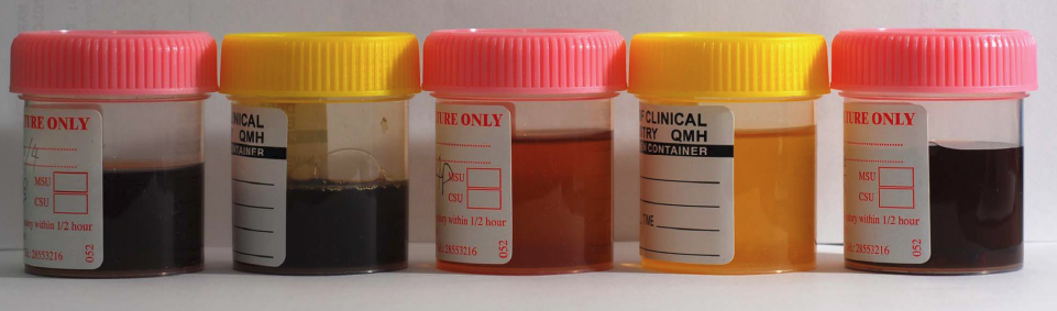 Serial urine samples in one of the interesting cases