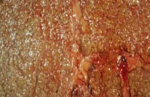 Cirrhotic liver